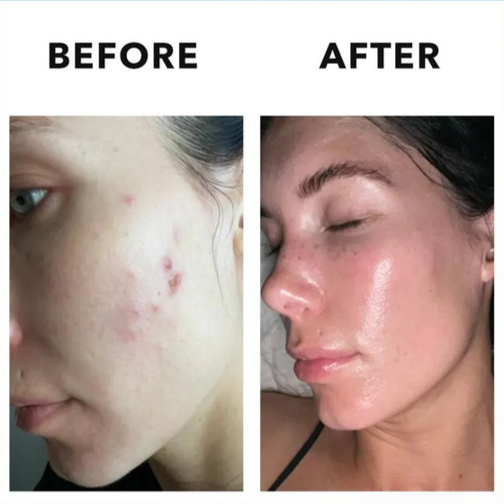 TruHealth® Hormonal Vitamin Acne Supplement