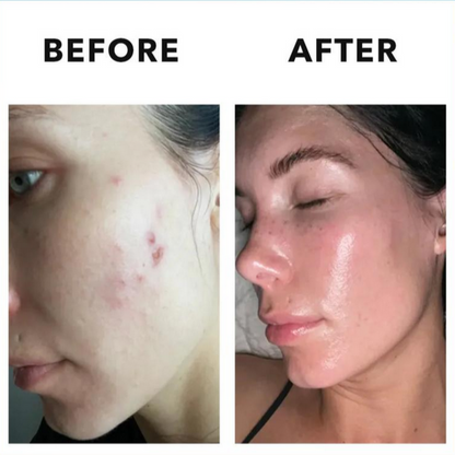 TruHealth® Hormonal Vitamin Acne Supplement